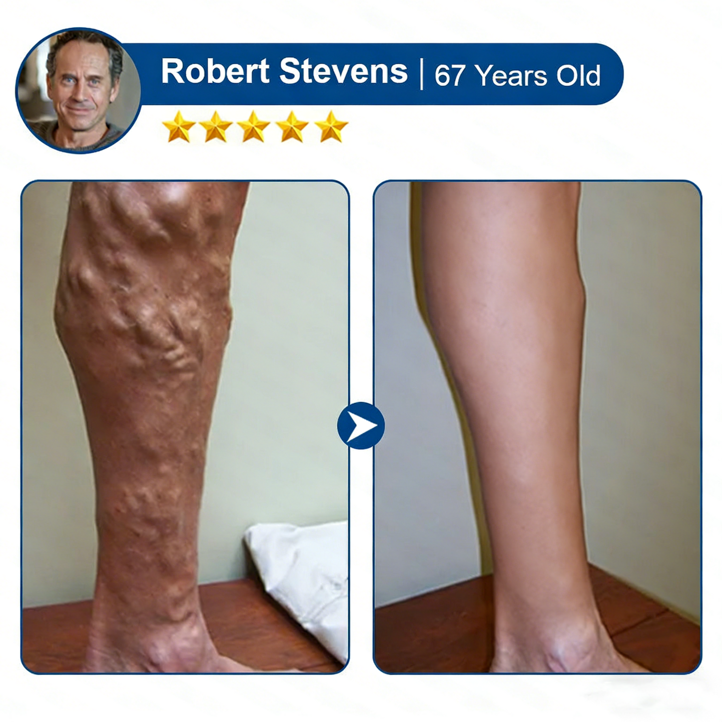 🌿 Hgfnvllc® Vein Contour Micro-Patch ✨ Diosmin & Hesperidin Leg Care Support-LUN