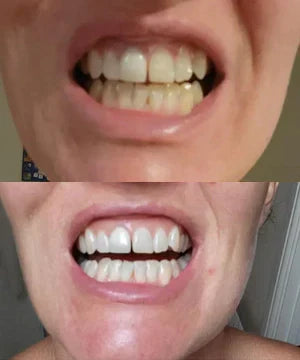 ✨Skavix Whitening Mouthwash – Stain Removal, Brighter Teeth & Fresh Breath-LUN