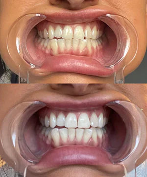 ✨Skavix Whitening Mouthwash – Stain Removal, Brighter Teeth & Fresh Breath-LUN