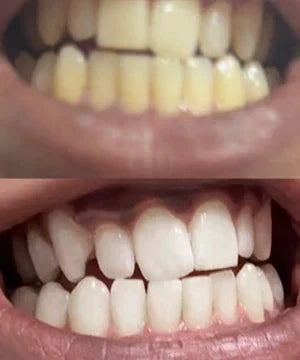 ✨Skavix Whitening Mouthwash – Stain Removal, Brighter Teeth & Fresh Breath-LUN